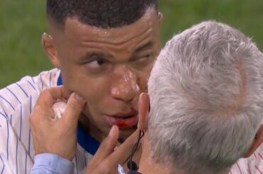 Kylian Mbappé et son nez déplacé